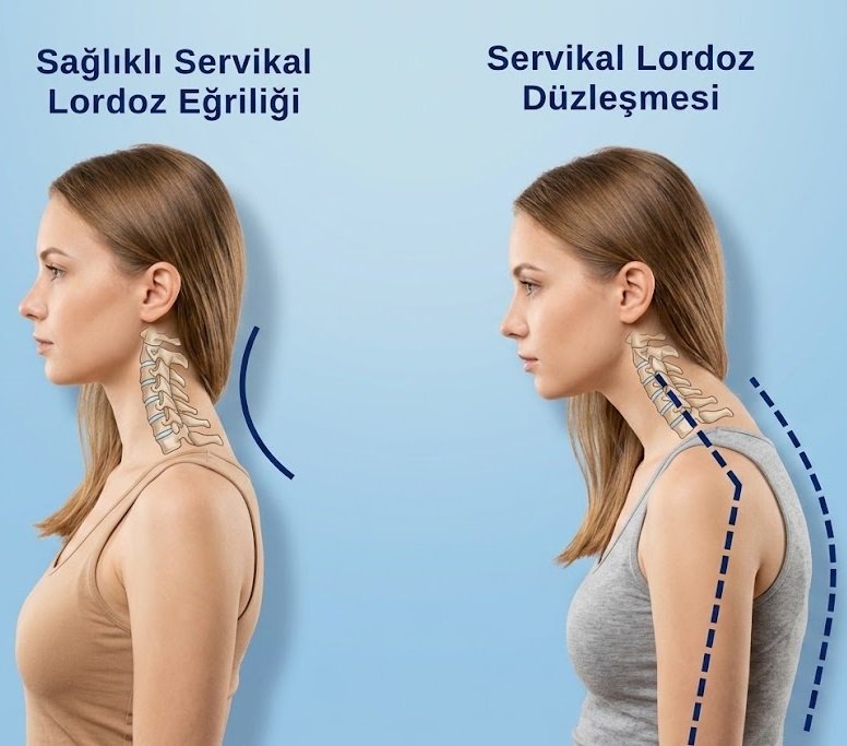 Sağlıklı servikal lordoz eğrisi ile servikal lordoz düzleşmesinin yandan karşılaştırılması